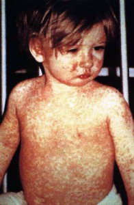 Child with measles, via Wikipedia/CDC